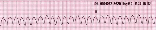 Ventricular tachycardia in lead II: fast, wide and monomorphic.