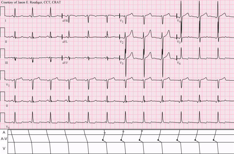 Wandering atrial pacemaker: P wave shape changes from beat to beat as the pacing site shifts.